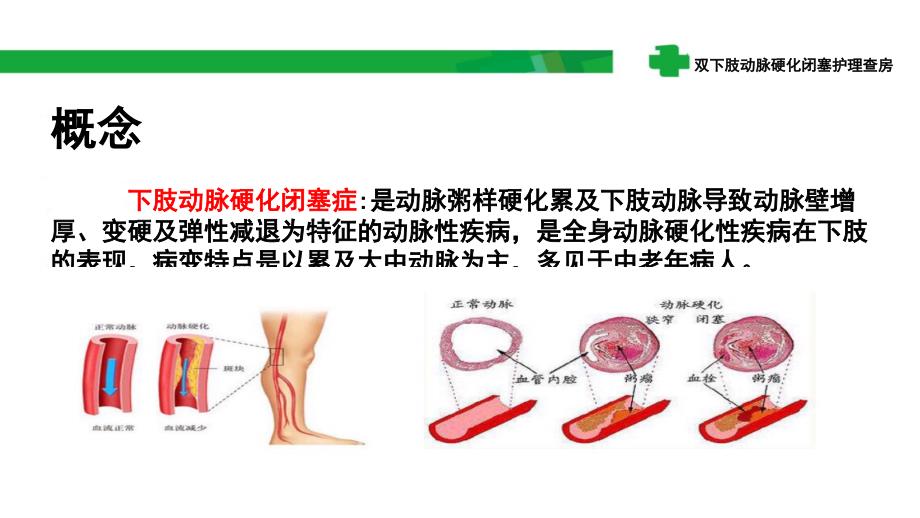 双下肢动脉硬化闭塞护理查房ppt课件_第3页