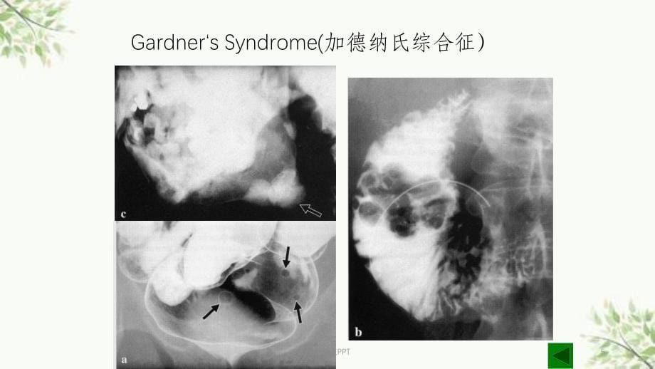 良性骨肿瘤影像诊断课件_第5页