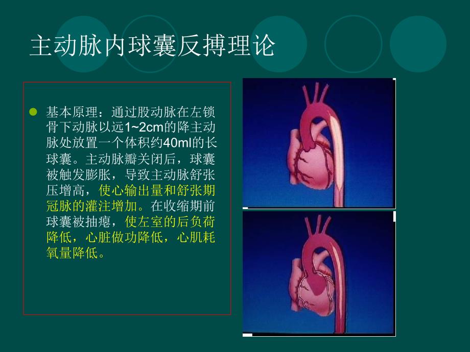 主动脉球囊反搏在心脏外科中_第4页