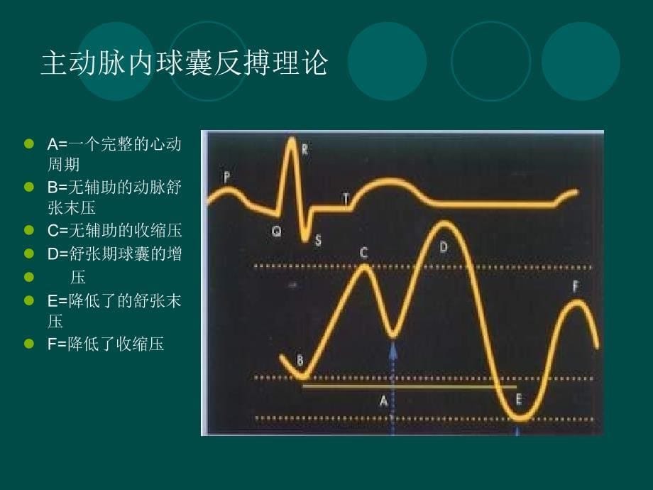 主动脉球囊反搏在心脏外科中_第5页