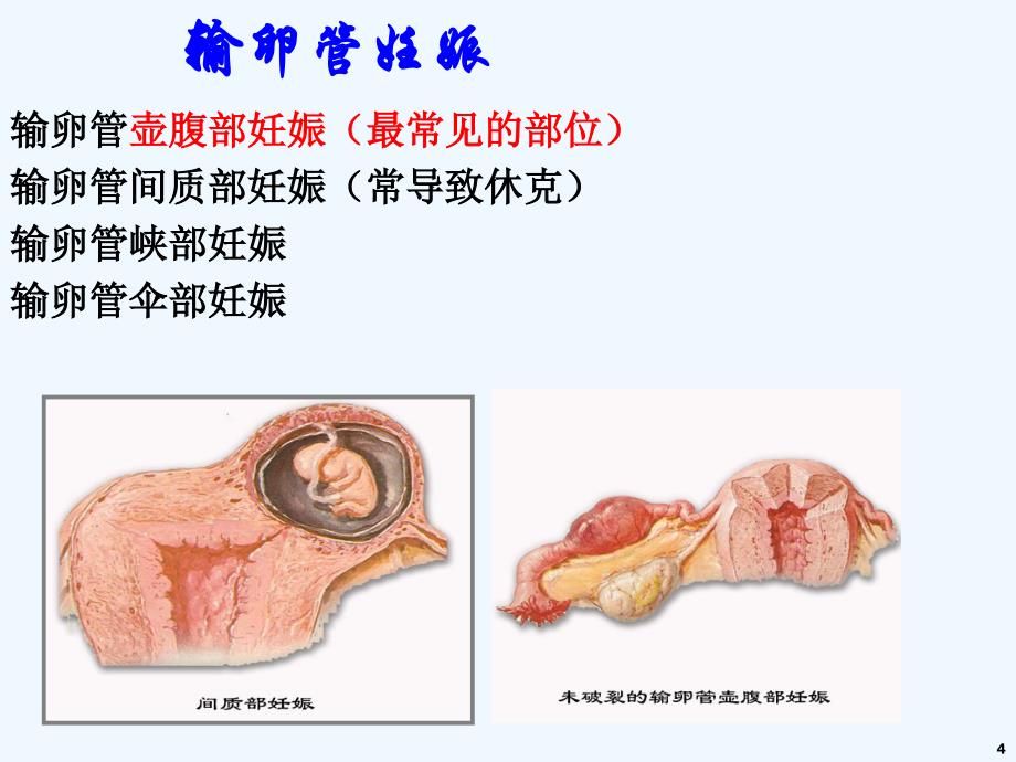 宫外孕图文并茂_第4页