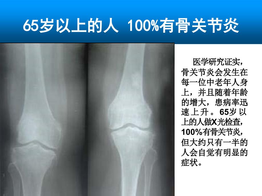 骨关节病知识课件_第2页