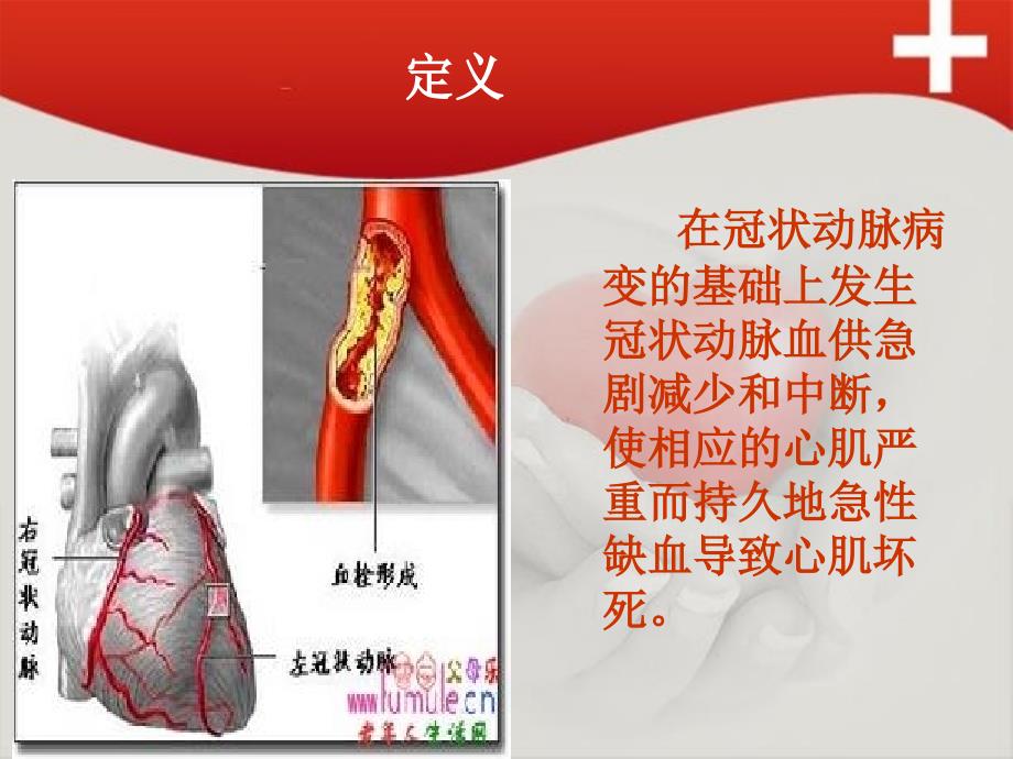 急性前壁心肌梗死护理查房ppt课件.ppt_第2页