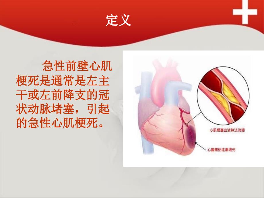 急性前壁心肌梗死护理查房ppt课件.ppt_第4页