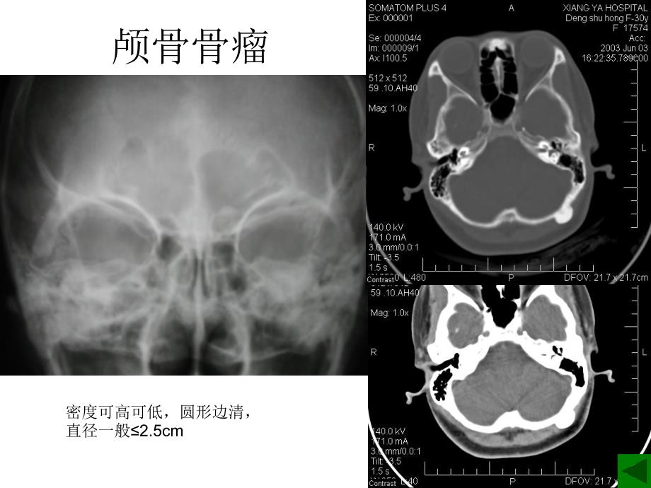 良性骨肿瘤影像诊断_第3页