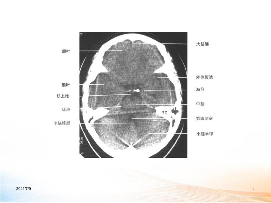 头颅CT读片教学课件_第4页