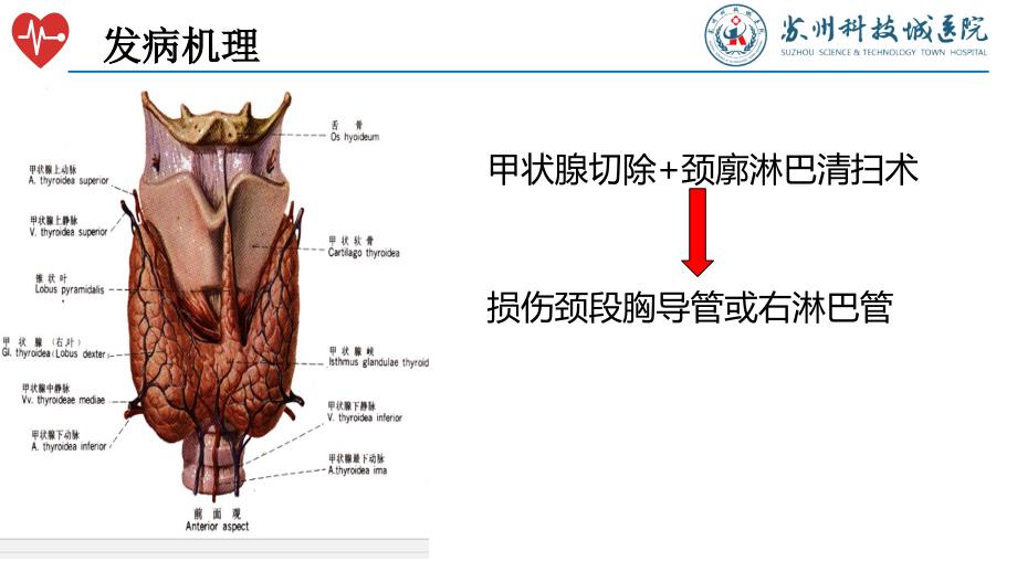 甲状腺术后淋巴漏的护理_第4页