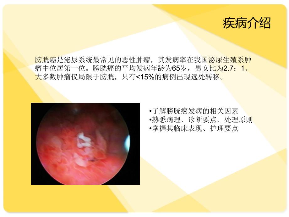 膀胱肿瘤病人的护理.ppt_第2页