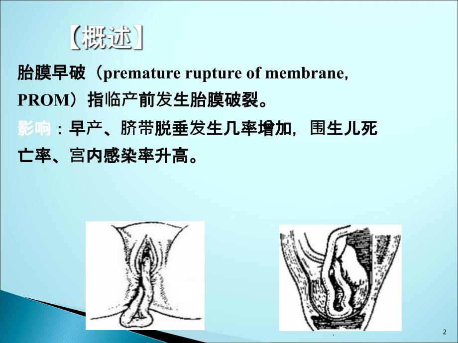 胎膜早破的护理课件_第2页