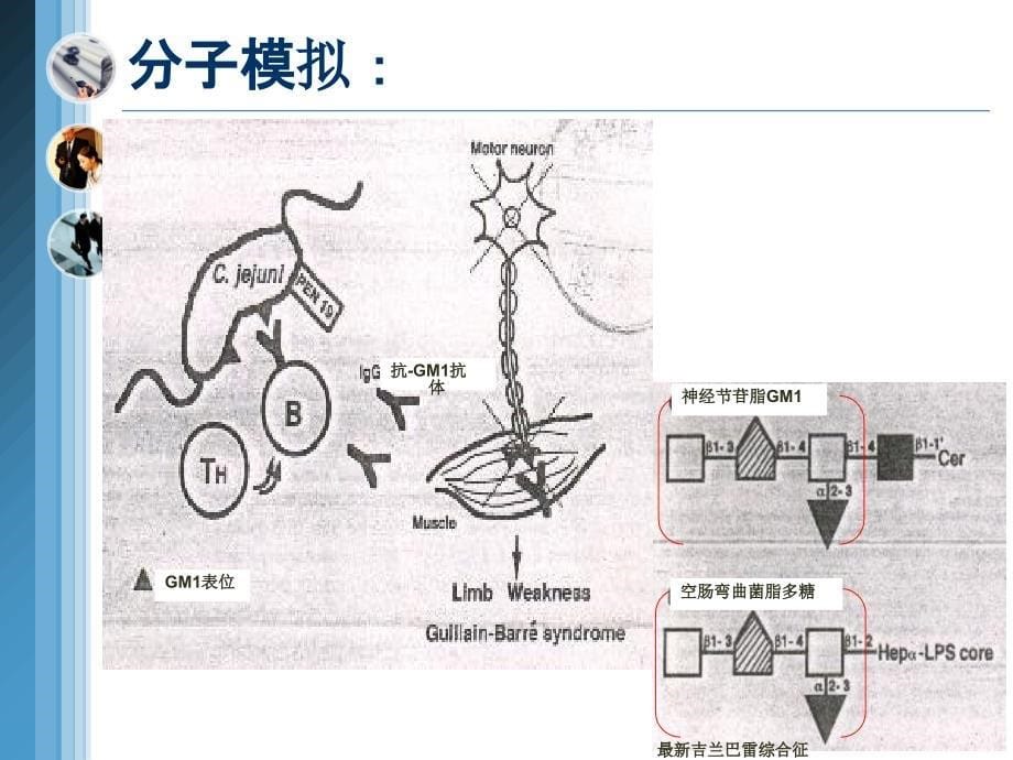 吉兰巴雷综合征_第5页