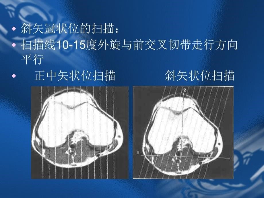 MRI骨关节影像诊断名师编辑PPT课件_第5页