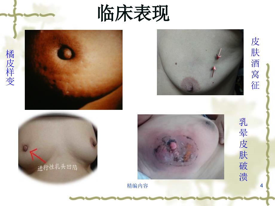 乳腺癌术后化疗后护理教学查房（深度分析）_第4页