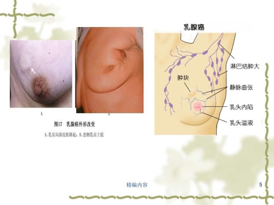 乳腺癌术后化疗后护理教学查房（深度分析）_第5页