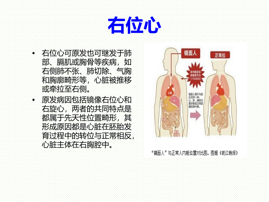 右位心心电图表现_第3页