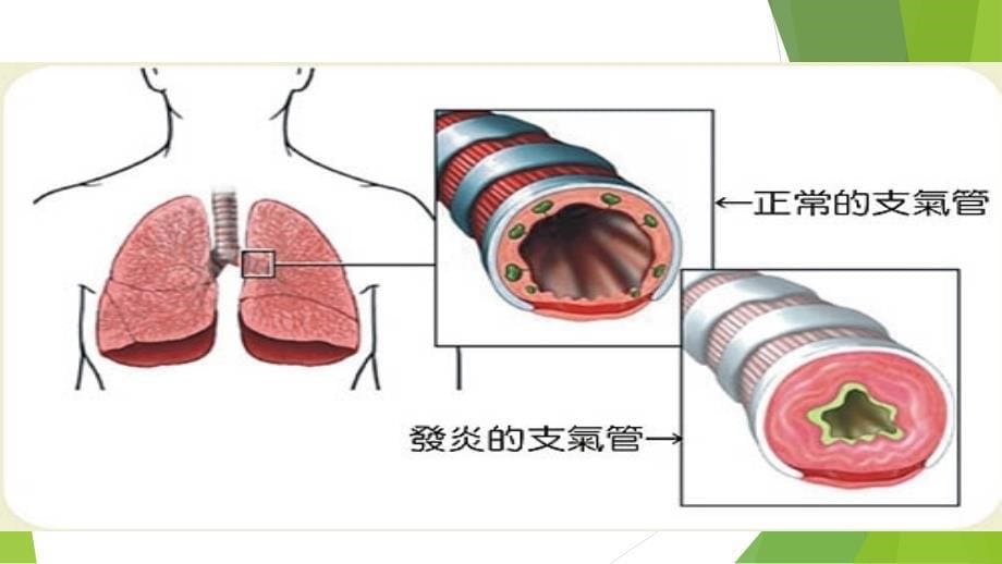 急性支气管炎护理_第5页