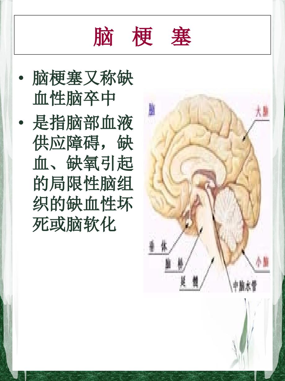 脑梗塞护理查房专题培训课件_第3页