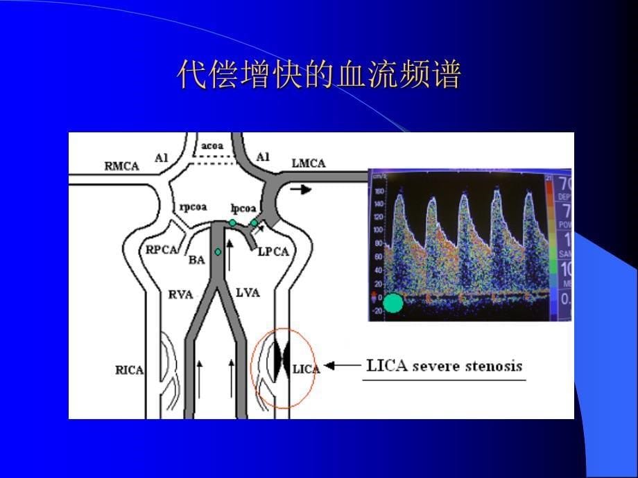 脑血流速度增快或减慢的病理意义_第5页