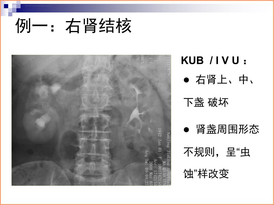 泌尿系结核典型病例影像资料ppt课件_第2页