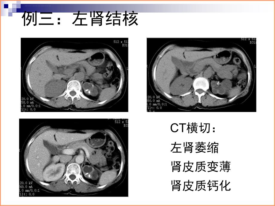 泌尿系结核典型病例影像资料ppt课件_第4页