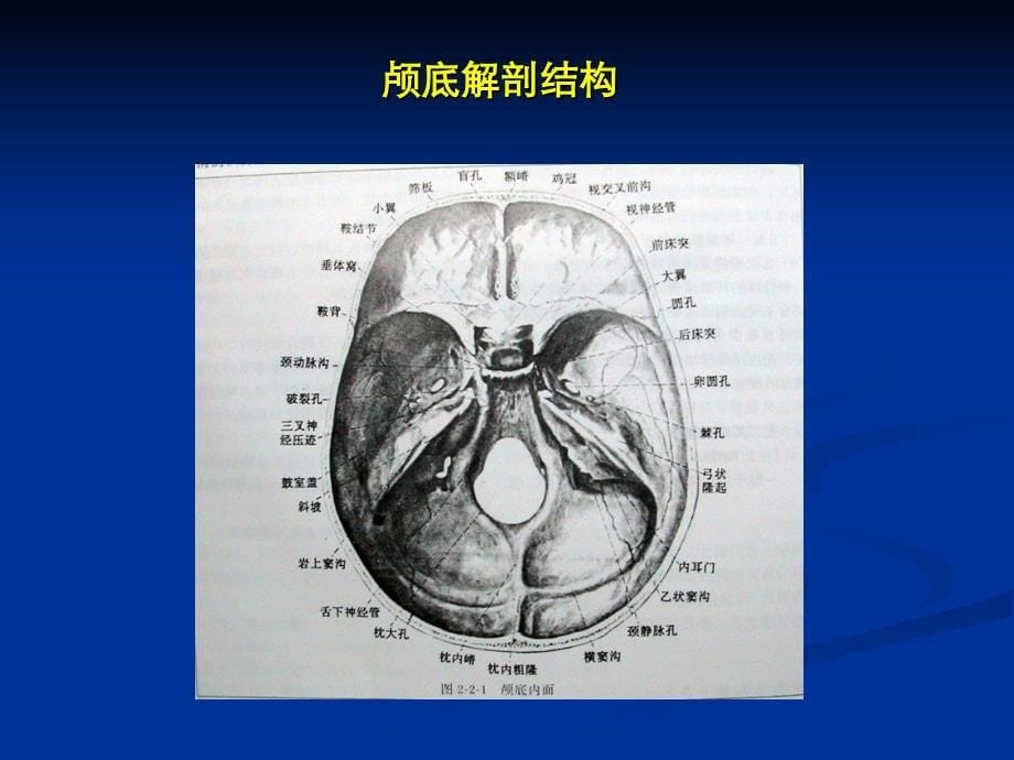 颅脑CT影像断层解剖_第5页