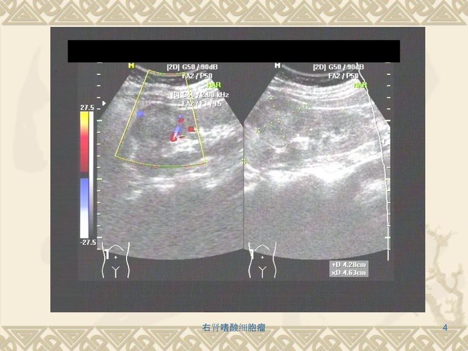 右肾嗜酸细胞瘤课件_第4页