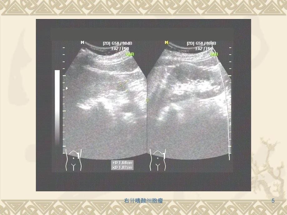 右肾嗜酸细胞瘤课件_第5页