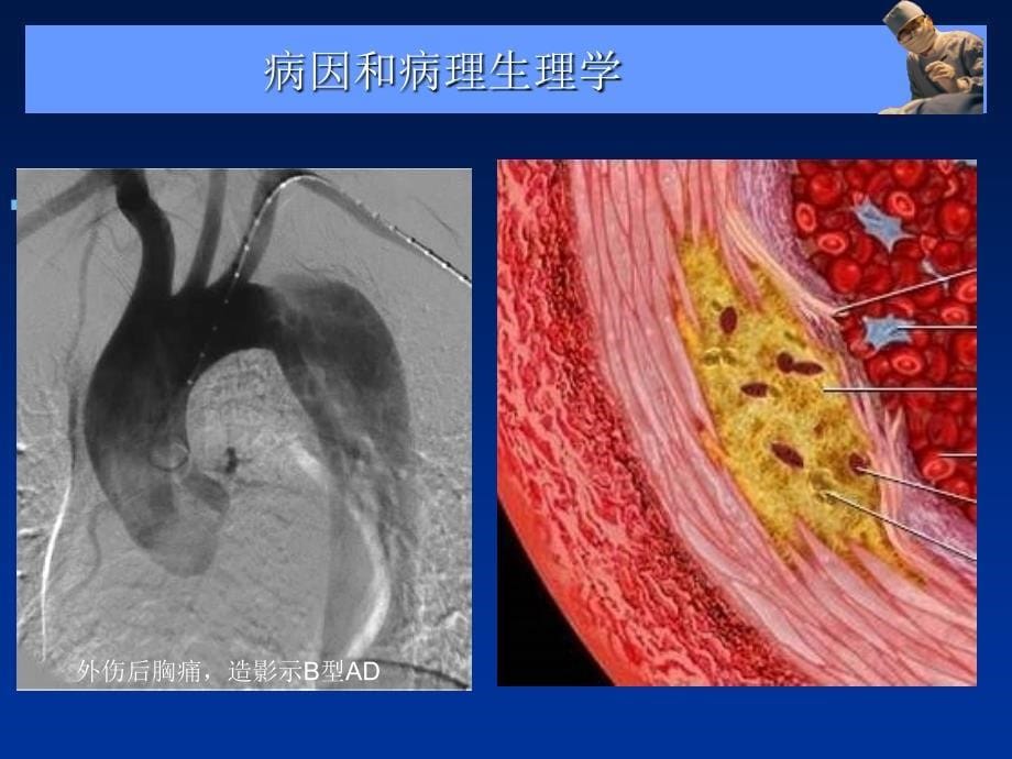 主动脉夹层、壁间血肿及穿通性溃疡的影像诊断与鉴别诊断_第5页