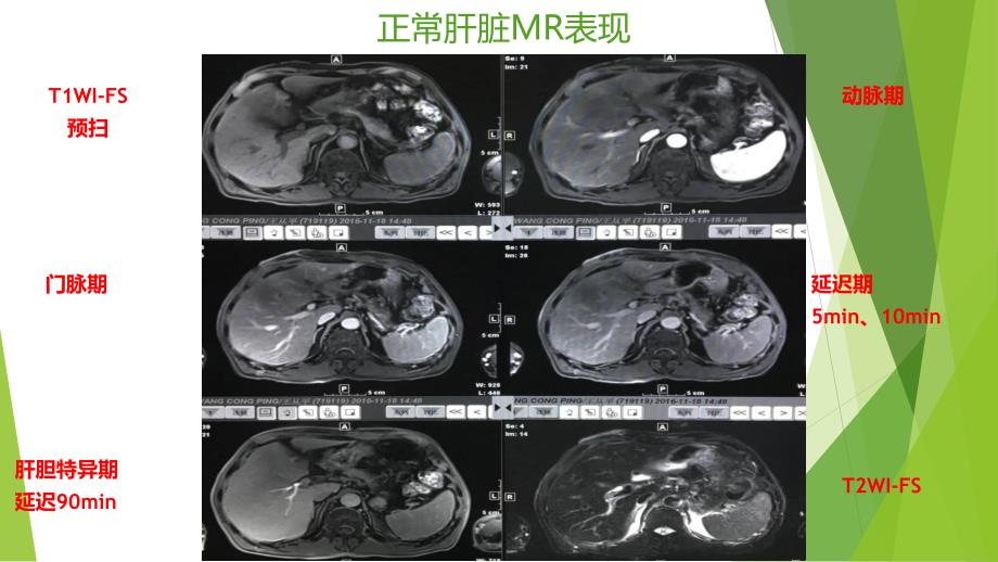 肝脏的MR表现_第2页