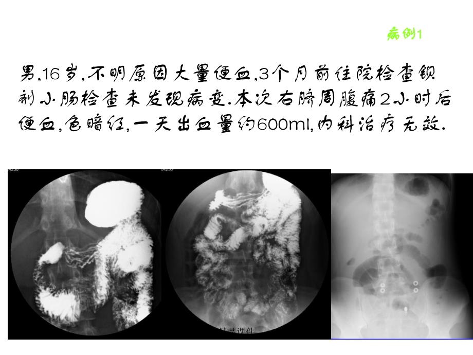 麦克尔憩室的影像学诊断课件_第2页