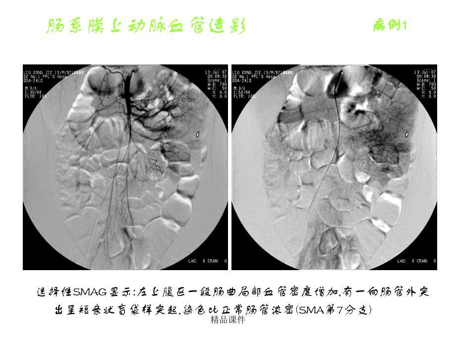 麦克尔憩室的影像学诊断课件_第3页