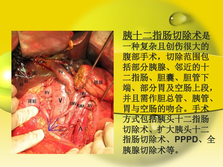 胰十二指肠切除术_第2页