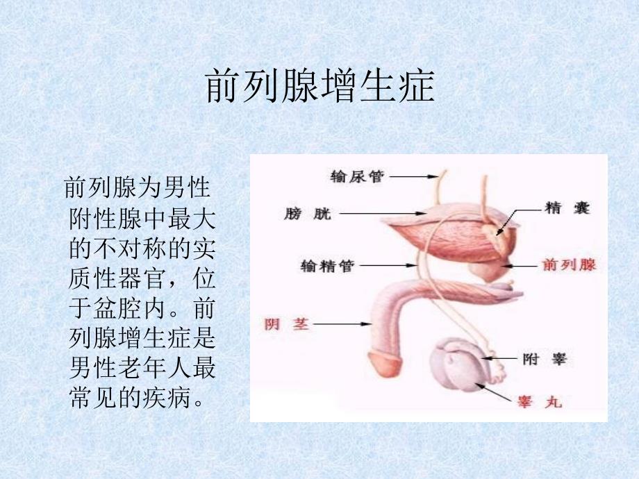 前列腺增生症PPT课件_第2页