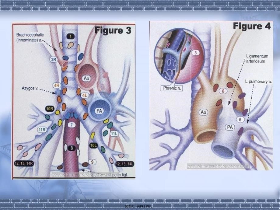 医学专题—纵隔淋巴结CT片_第5页