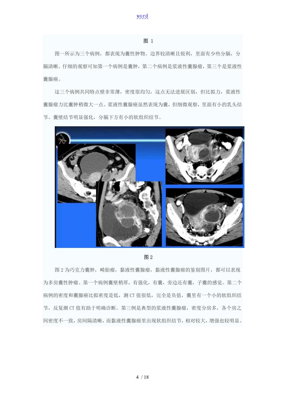 卵巢肿瘤地鉴别诊断_第4页