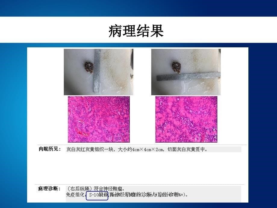 胃神经鞘瘤的诊断与鉴别诊断_第5页