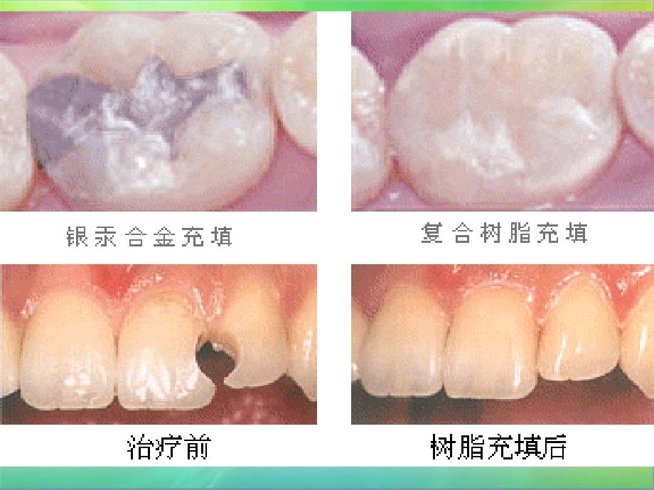 牙科树脂充填_第1页