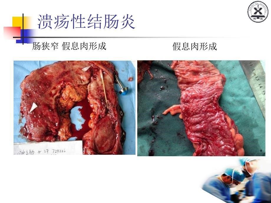 大肠癌晏教授讲义_第5页