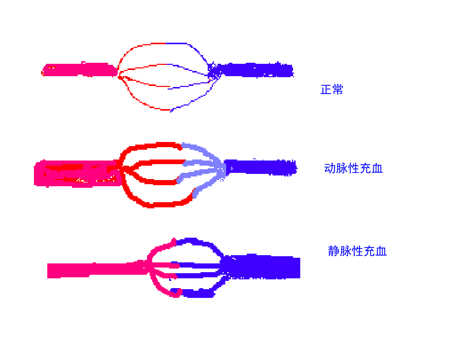 病理学第三章局部血液循环障碍01115_第4页