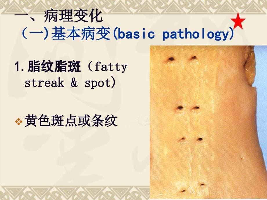 AS冠心病说课材料_第5页