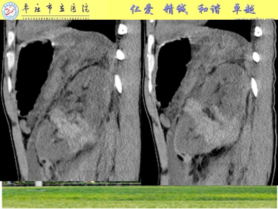 《肾脏损伤分级》PPT课件.ppt_第2页