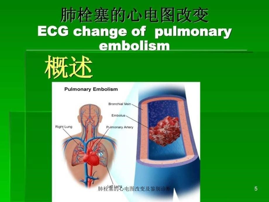 肺栓塞的心电图改变及鉴别诊断课件_第5页