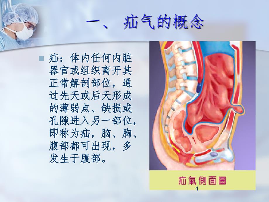 疝气护理.ppt_第4页