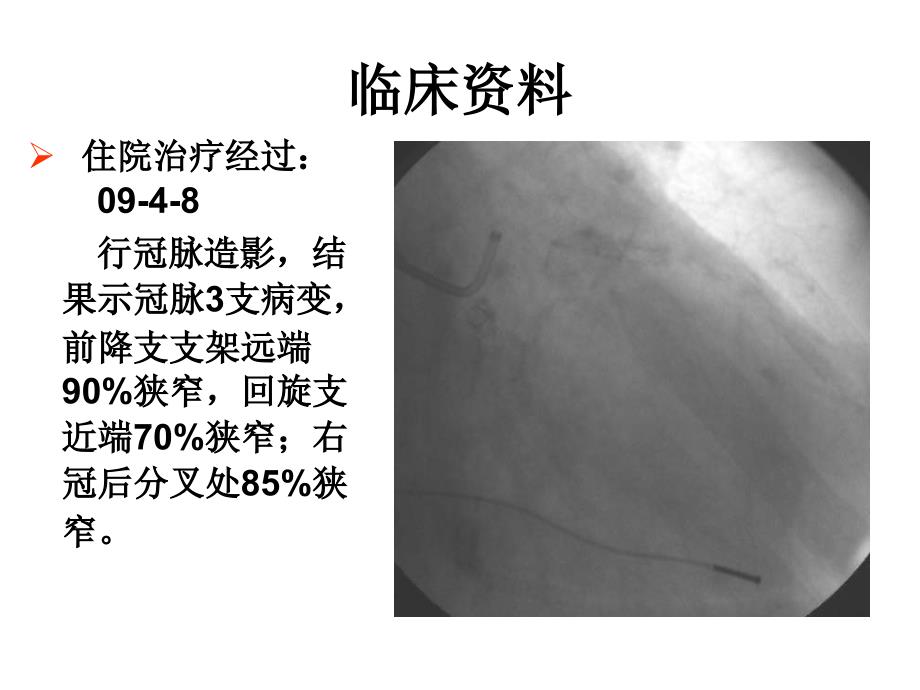 低分子肝素致腰臀部肌肉多发血肿1例_第4页