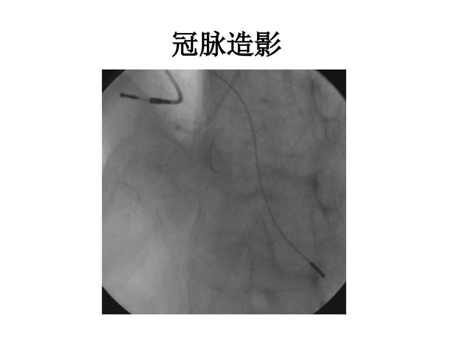 低分子肝素致腰臀部肌肉多发血肿1例_第5页