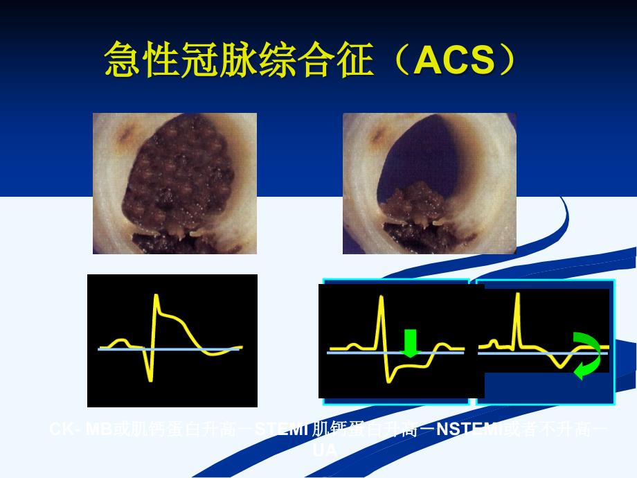 急性冠脉综合症-tr课件_第3页