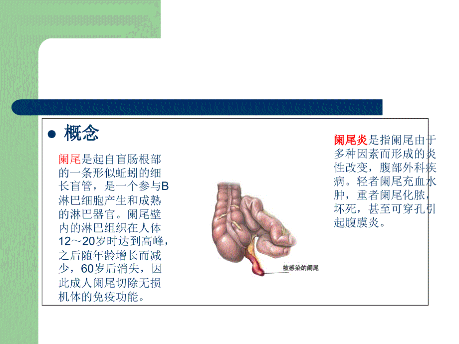 阑尾炎健康宣教_第2页