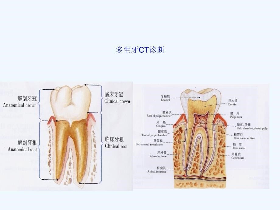 多生牙CT诊断_第5页