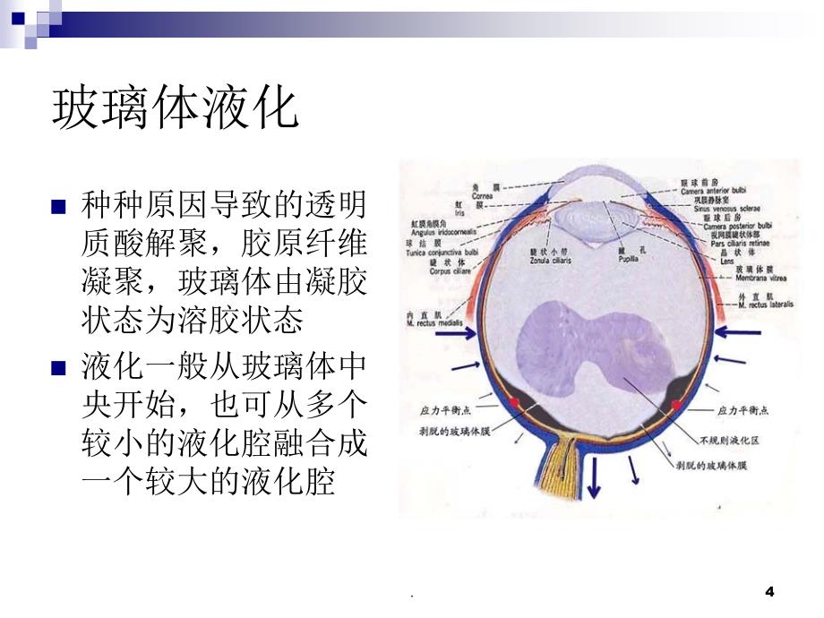 玻璃体液化及玻璃体积血ppt演示课件_第4页