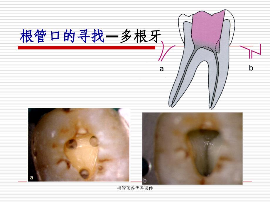 根管预备优秀课件_第2页