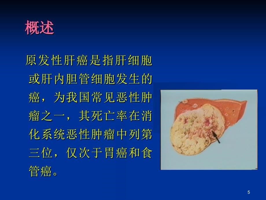 原发性肝癌病人的护理课件_第5页